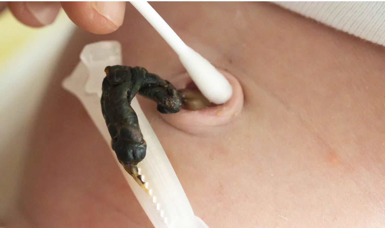 Cordão Umbilical