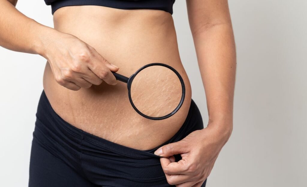 Estrias na gravidez: como entender, prevenir e cuidar da sua pele