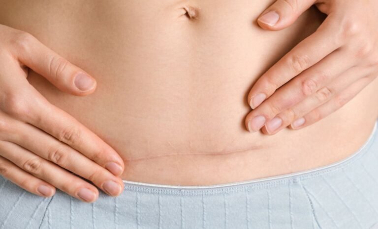 Cuidados com a Cicatriz da Cesariana: Dicas para uma Boa Recuperação